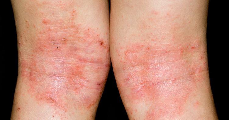 bệnh chàm Eczema