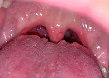 Viêm họng hạt ở lưỡi có nguy hiểm không? Cách chữa trị như thế nào?