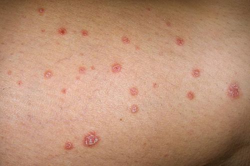 Bệnh nấm Candida ngoài da gây ra như thế nào?