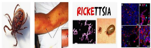 bệnh Typhus Rickettsia Pneumonia