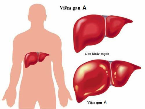 bệnh viêm gan A