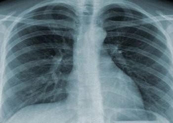 Bệnh viêm phổi do Pneumocystis carinii, triệu chứng, cách kiểm tra