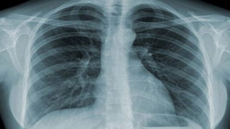 bệnh viêm phổi do Pneumocystis carinii