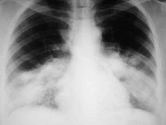 bệnh viêm phổi hình cầu