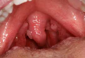 Các hạng mục kiểm tra đối với bệnh giun tròn miệng hàm mặt là gì?