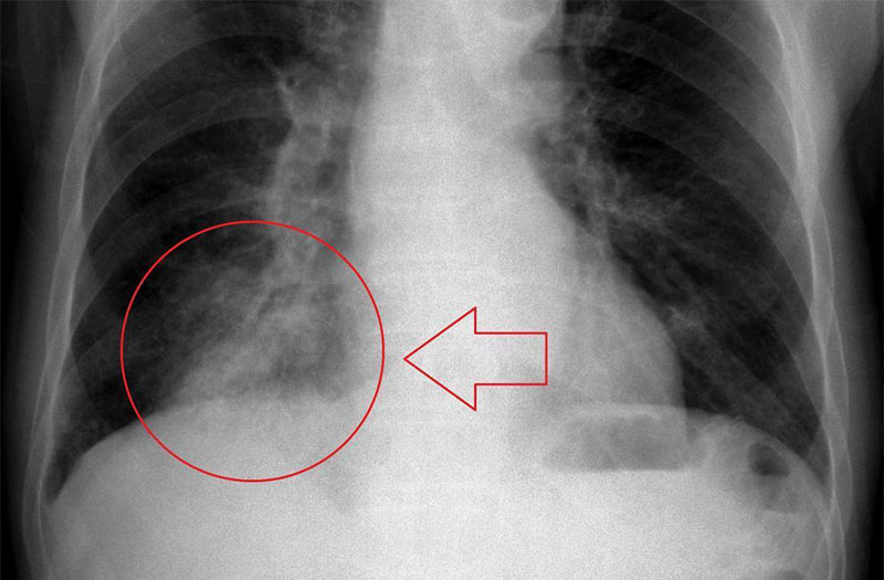 Các hạng mục kiểm tra đối với bệnh viêm phổi do Pneumocystis carinii là gì?