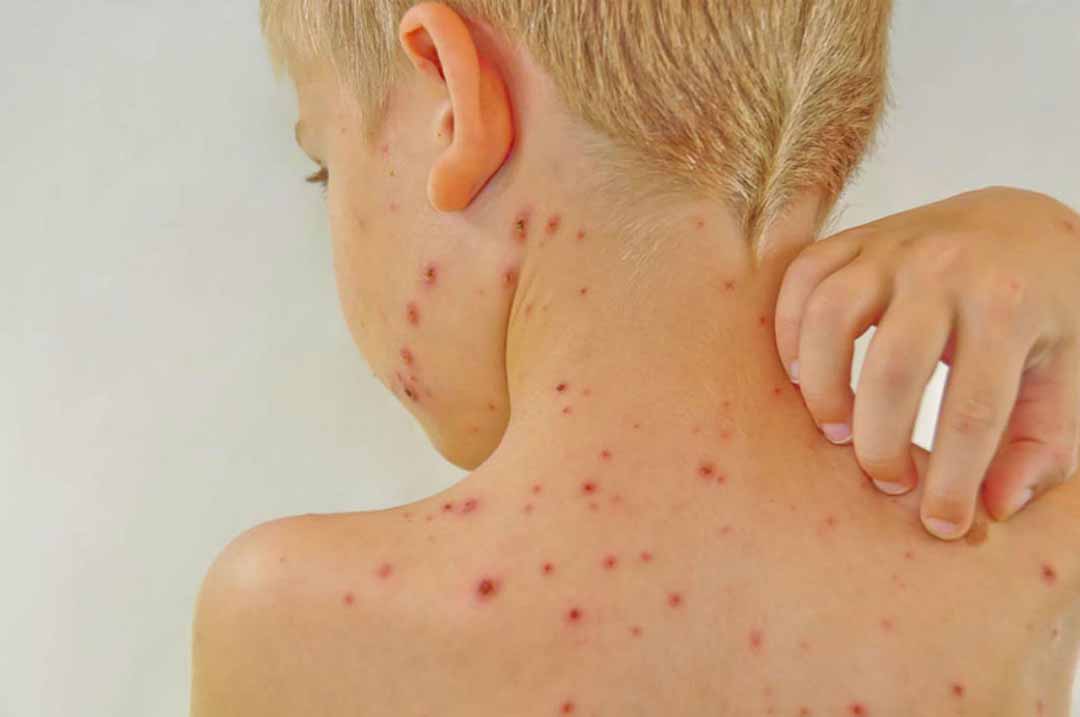 Các phương pháp điều trị bệnh sỏi da là gì?