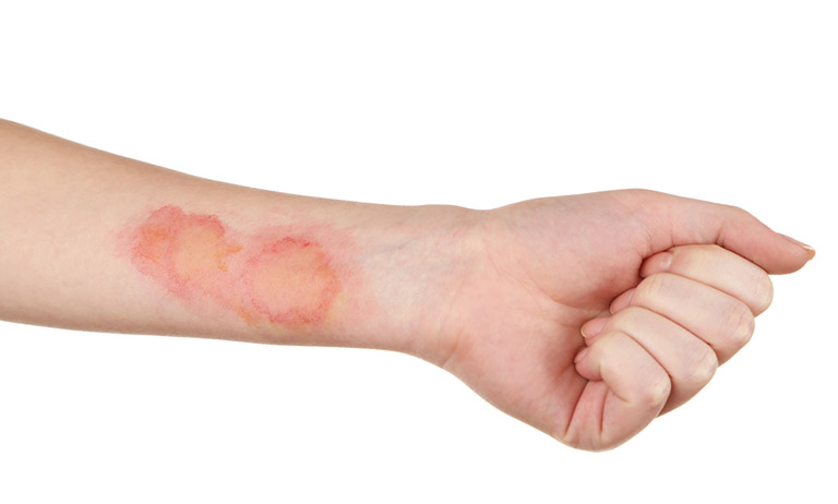 Các triệu chứng của bệnh nhiễm trùng da là gì?