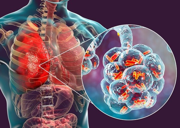 Các triệu chứng của bệnh viêm phổi do vi khuẩn ruột là gì?