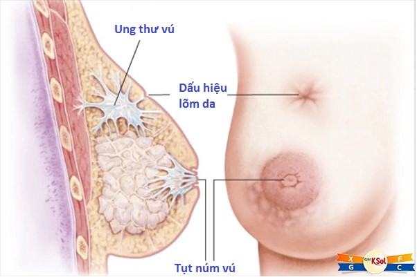 Các triệu chứng của ung thư vú là gì?