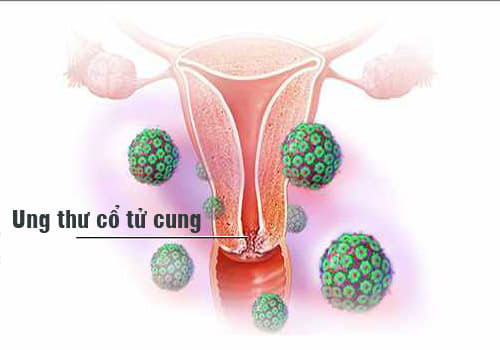 Chế độ ăn uống ung thư cổ tử cung