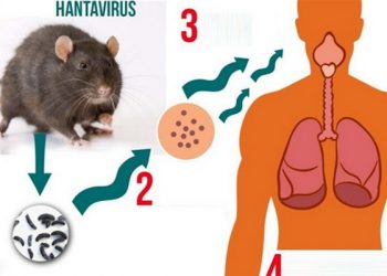 Hội chứng phổi Hantavirus – Các triệu chứng và cách phòng ngừa