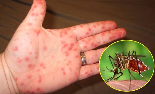 Làm thế nào để phân biệt và chẩn đoán sốt xuất huyết do virus?