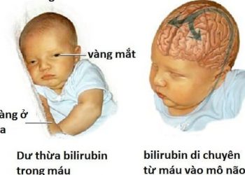 Tổng quan về bệnh não tăng bilirubin ở trẻ sơ sinh
