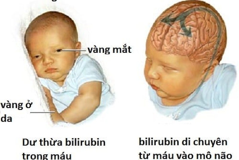 bệnh não tăng bilirubin