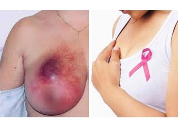 Ung thư vú – Nguyên nhân, triệu chứng và cách phòng tránh bệnh