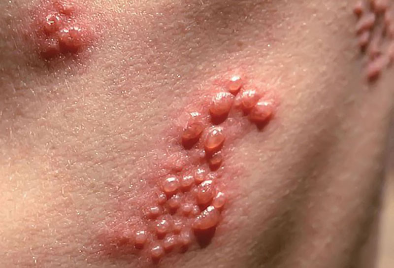 Viêm phổi do virus herpes simplex gây ra như thế nào?