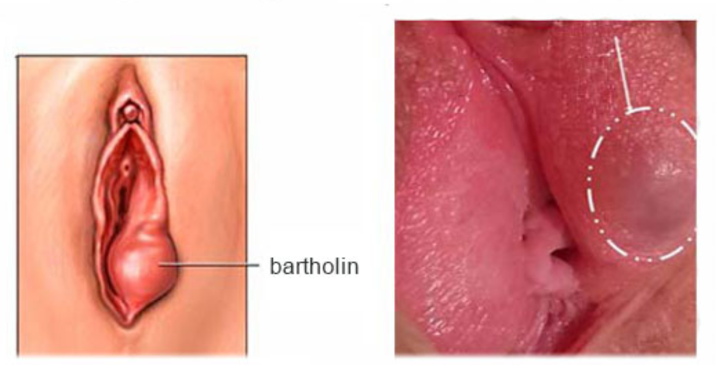 Bartholinitis là bệnh gì?