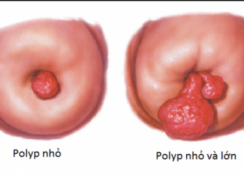 Bệnh polyp cổ tử cung là gì? Nguyên nhân sinh ra bệnh
