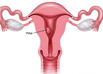 Bệnh polyp tử cung là gì? Nguyên nhân và hướng điều trị