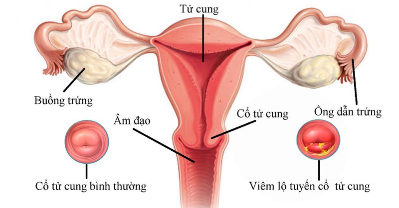 Bệnh viêm cổ tử cung do amebic là gì?