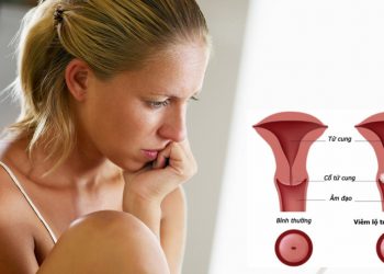 Bệnh viêm lộ tuyến cổ tử cung là gì? Những thông tin chung về bệnh