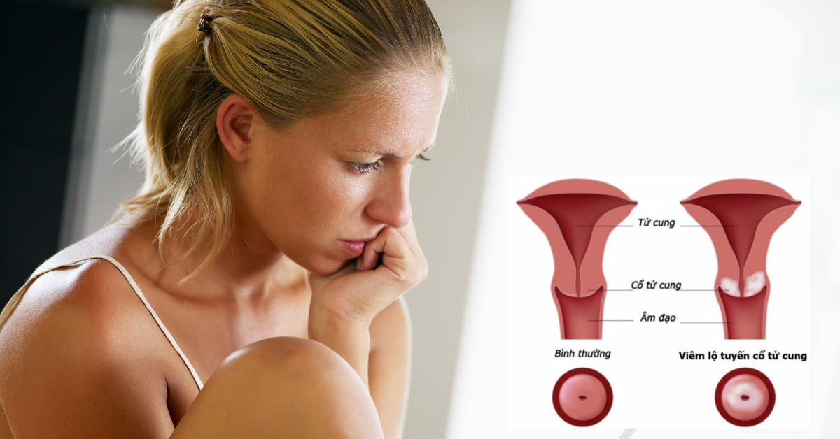 Bệnh viêm lộ tuyến cổ tử cung có thể gây ra những bệnh gì?