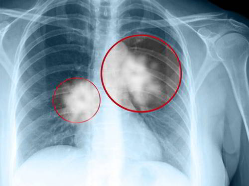 Các hạng mục giám định khối u phổi là gì?