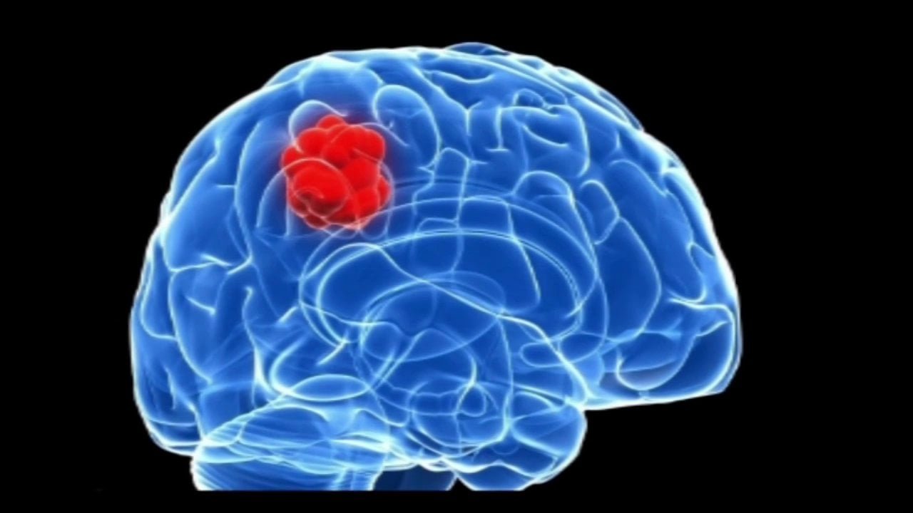 Các phương pháp điều trị rối loạn tâm thần liên quan đến khối u nội sọ là gì?