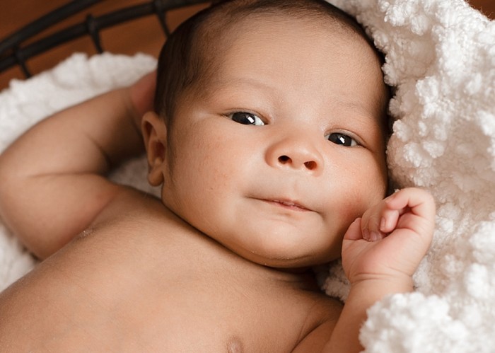 Các triệu chứng của bệnh u xơ kỹ thuật số ở trẻ sơ sinh là gì?
