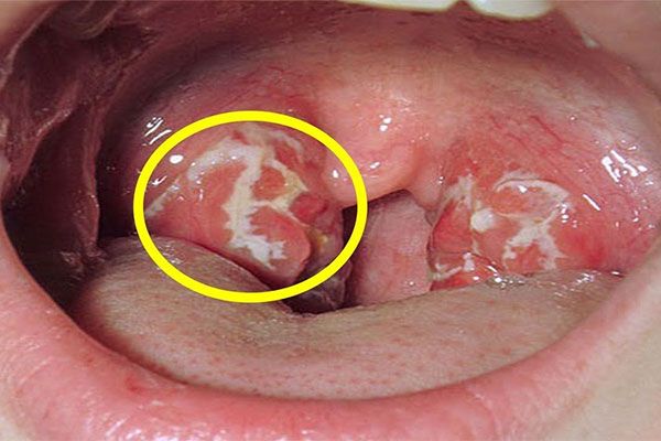 Các triệu chứng của bệnh ung thư vòm miệng mềm là gì?