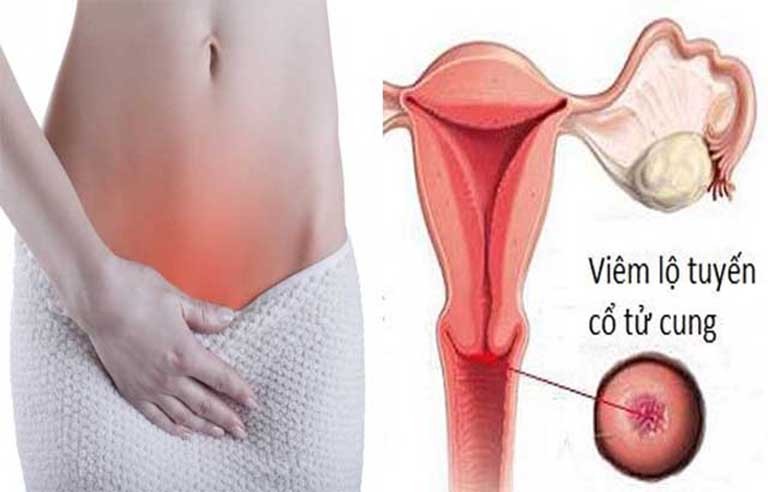 Các triệu chứng của bệnh viêm lộ tuyến cổ tử cung là gì?