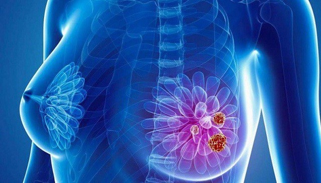 Các triệu chứng của khối u vú là gì?