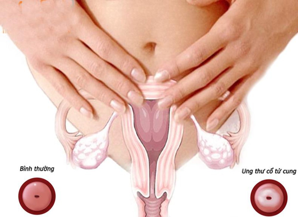 Các triệu chứng của nhiều bệnh ung thư nguyên phát ở đường sinh dục nữ là gì?