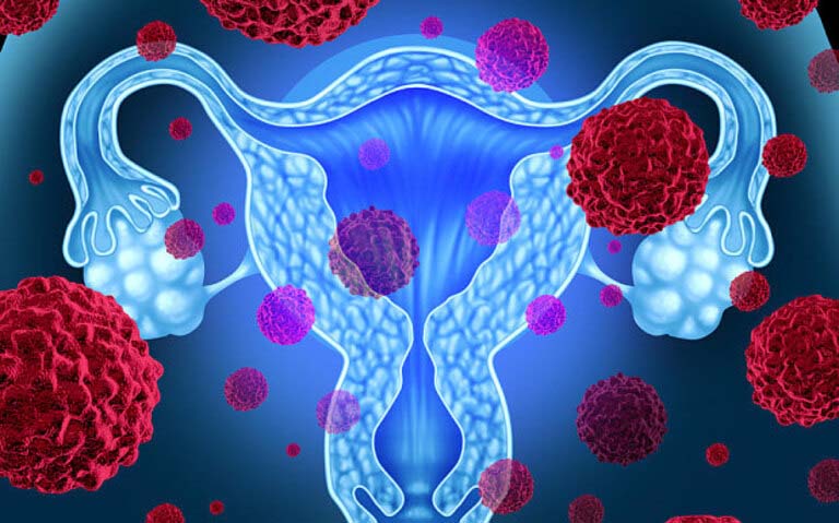 Các triệu chứng của khối u xoang nội bì âm đạo là gì?