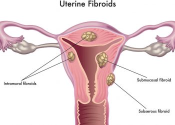 Leiomyoma của Vulva là gì? Triệu chứng gây bệnh, chế độ ăn, cách chữa
