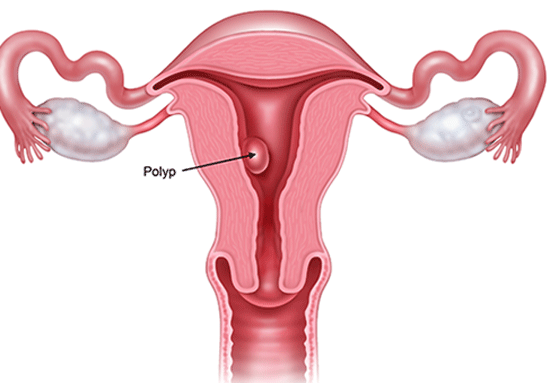 Polyp nội mạc tử cung là gì?