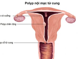 Polyp nội mạc tử cung là gì? Nguyên nhân và cách chữa