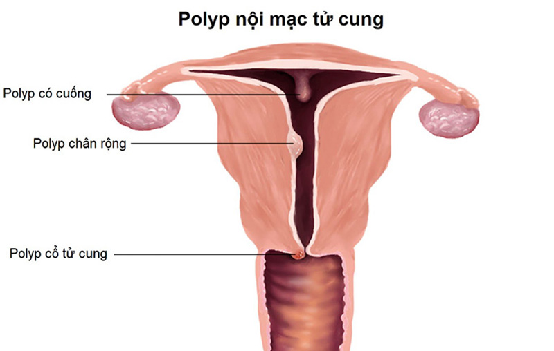 Polyp nội mạc tử cung là gì? 