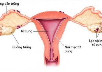 Tăng sản nội mạc tử cung là gì? Nguyên nhân và cách trị