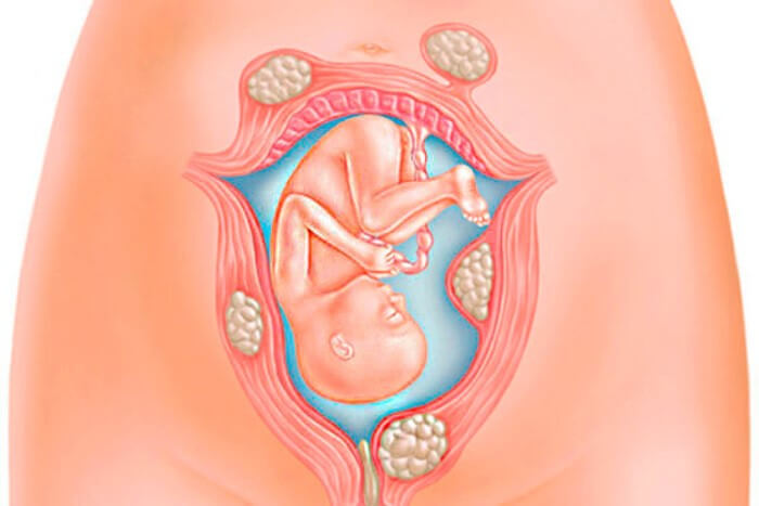 thai nghén bị u xơ tử cung