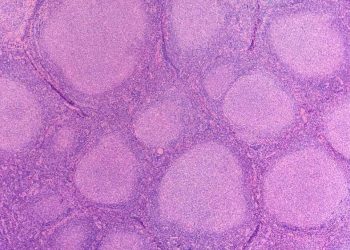 U lympho tế bào lớn dương tính CD30 ở da thứ cấp là gì?
