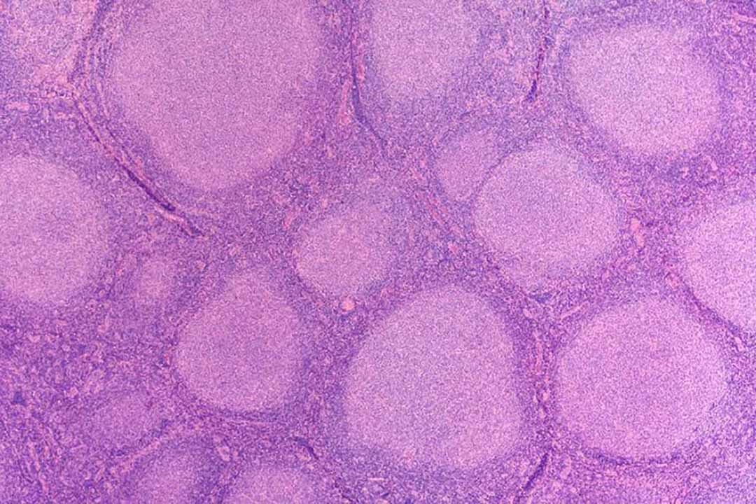 u lympho tế bào lớn dương tính CD30 ở da thứ cấp