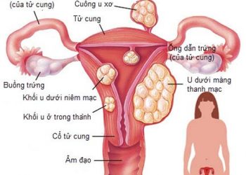U xơ cổ tử cung là gì? Những thông tin mới nhất về bệnh