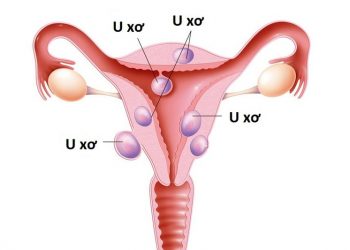 U xơ tuyến mồ hôi tử cung là gì? Những dấu hiệu và cách đề phòng