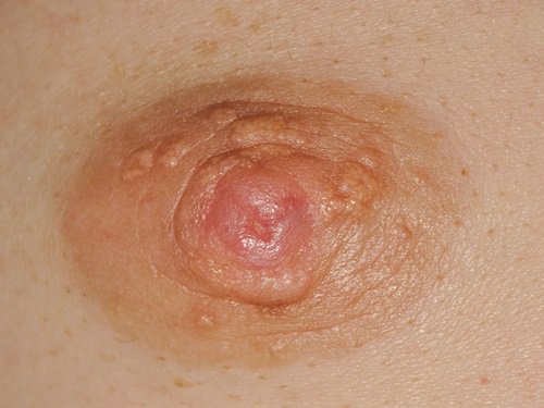ung thư biểu mô dạng chàm ngoài vú