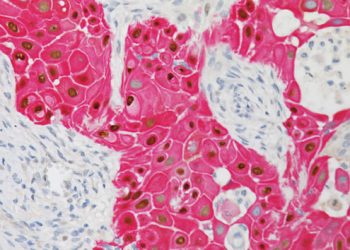 Ung thư biểu mô tế bào vảy xâm lấn của âm hộ là gì? Dấu hiệu nhận biết bệnh