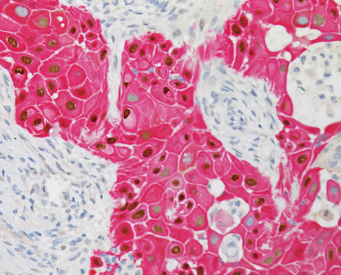 ung thư biểu mô tế bào vảy xâm lấn của âm hộ