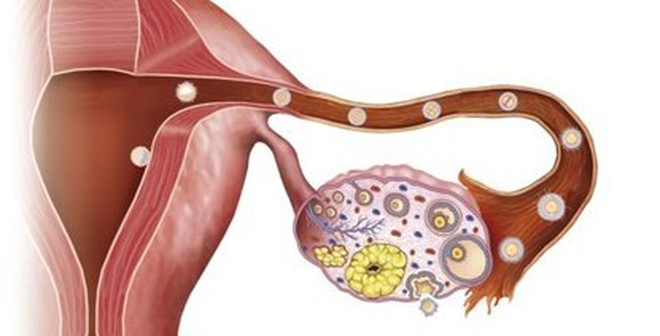 ung thư biểu mô tuyến sinh dục dạng ống