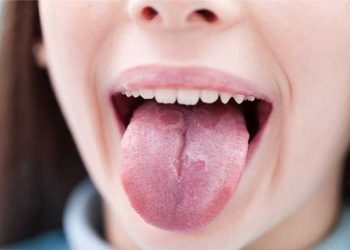 Ung thư lưỡi là gì? Tất tần tật thông tin về bệnh